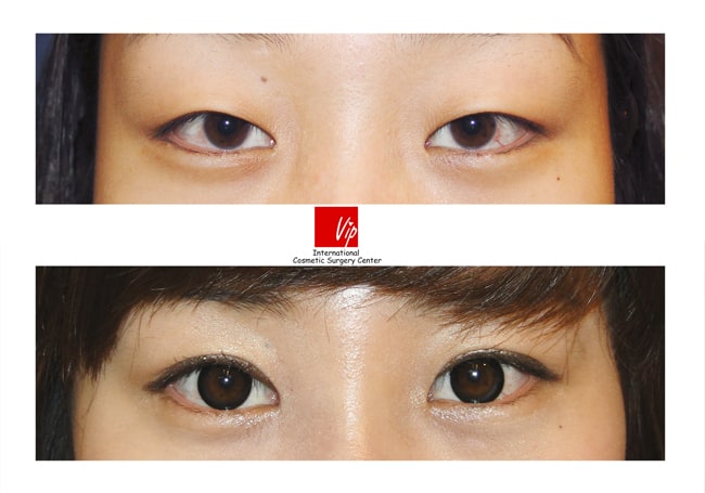 	Eye Surgery, Ptosis Correction	 - Ptosis correction