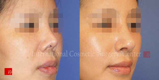 	Harmony-Rhinoplasty, Protruded Mouth Correction Rhinoplasty, Rib cartilage Rhinoplasty, Contracted Nose, Revision Rhinoplasty	 - Harmony rhinoplasty - 100% Rib cartilage