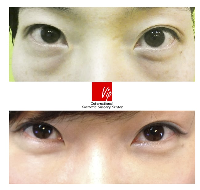 	Lower Blepharoplasty	 - Fat transfer under one&#39;s eyes