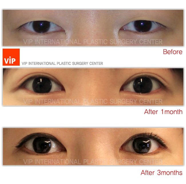 	Eye Surgery, Double Fold, Ptosis Correction	 - Ptosis correction