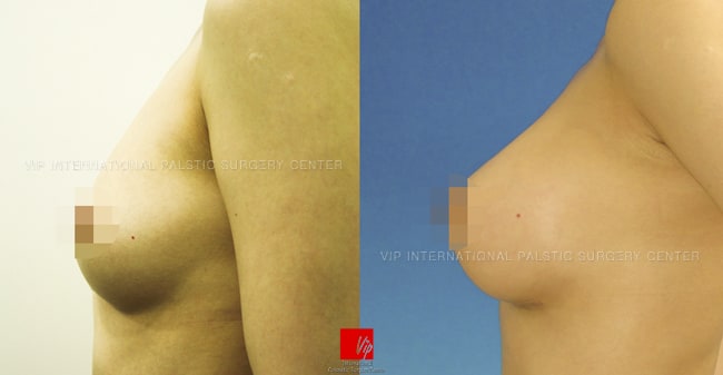	Breast Surgery, Body Contouring	 - VIP Tear drop augmentation