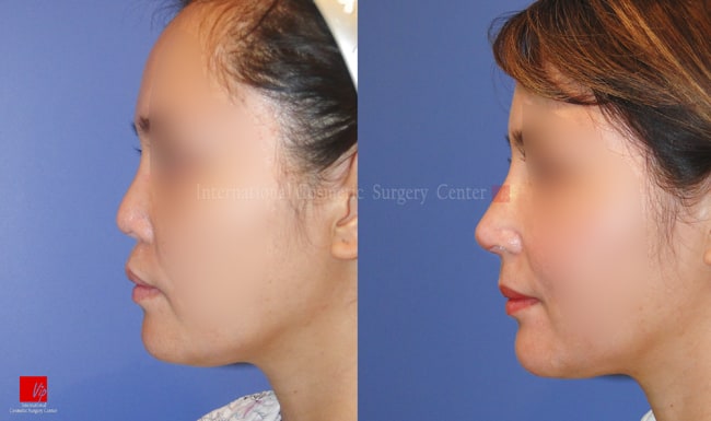 	Harmony-Rhinoplasty, Protruded Mouth Correction Rhinoplasty, Rib cartilage Rhinoplasty, Contracted Nose, Revision Rhinoplasty	 - VIP Harmony face with Rib cartilage