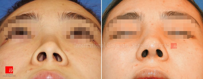 	Harmony-Rhinoplasty, Protruded Mouth Correction Rhinoplasty, Revision Rhinoplasty	 - Rib cartilage rhinoplasty-silicone infection