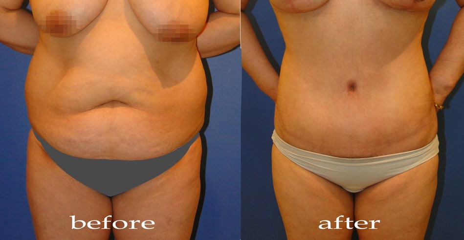 	Body Contouring	 - Liposuction