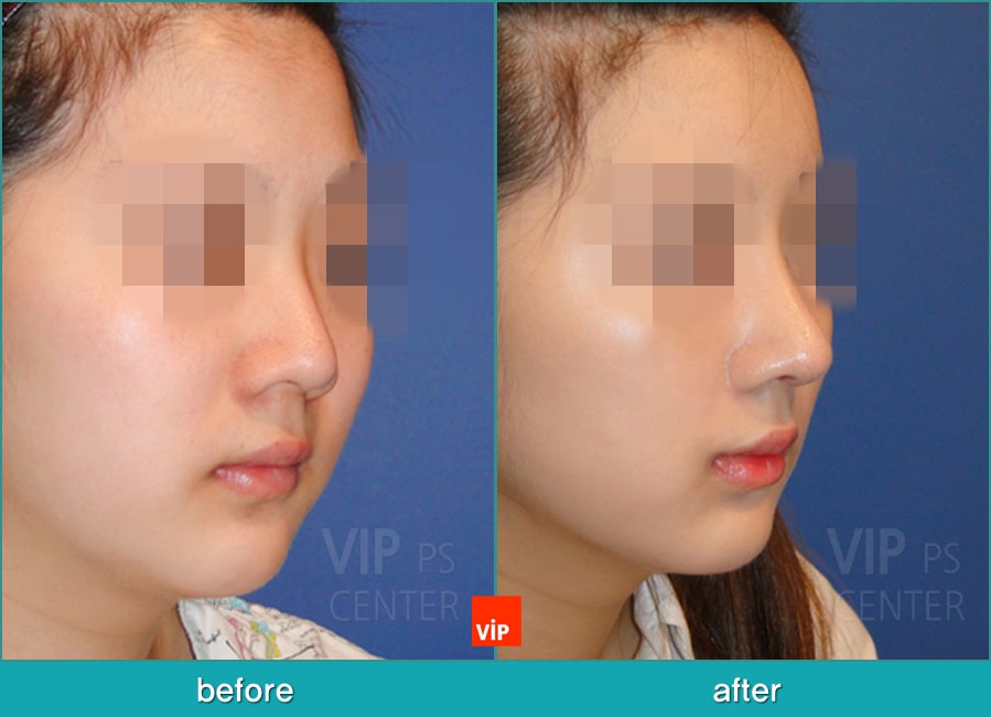 	Nose Surgery, Each Cases Nose, Septal Deviation	 - Septal Deviation