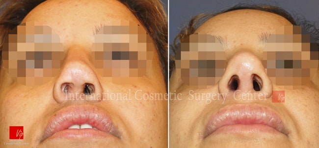 	Nose Surgery, Harmony-Rhinoplasty, Rib cartilage Rhinoplasty, Contracted Nose, Revision Rhinoplasty	 - 2nd Rib cartilage Op.- Nostril obstruction  by car accident