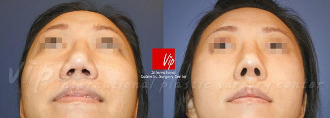 	Nose Surgery, Protruded Mouth Correction Rhinoplasty, Rib cartilage Rhinoplasty	 - Autologous rhinoplasty