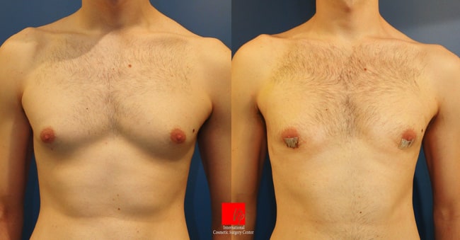 	Breast Surgery	 - Gynecomastia