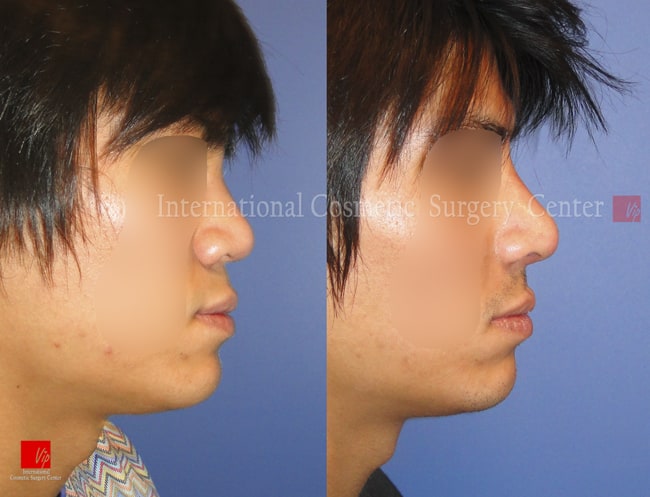 	Harmony-Rhinoplasty, Protruded Mouth Correction Rhinoplasty, Rib cartilage Rhinoplasty	 - Male rhinoplasty