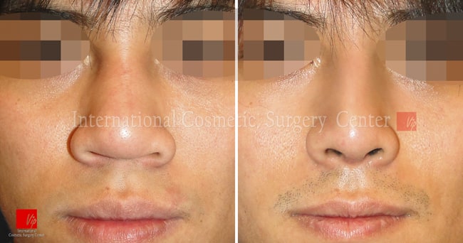 	Harmony-Rhinoplasty, Protruded Mouth Correction Rhinoplasty, Rib cartilage Rhinoplasty	 - Male rhinoplasty