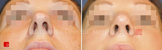 	Nose Surgery, Harmony-Rhinoplasty, Each Cases Nose	 - Septal deviation - Caucasian