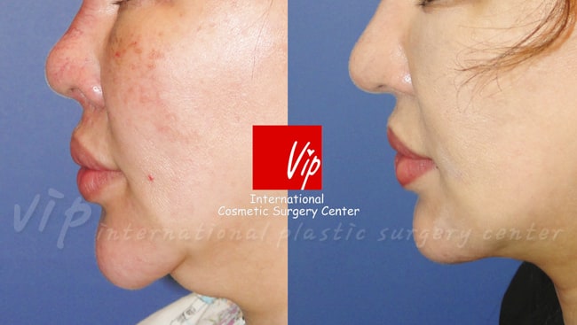 	Rib cartilage Rhinoplasty, Revision Rhinoplasty, Each Cases Nose	 - Autologous Rhinoplasty - Dermis