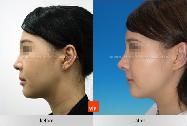 Nose Surgery - Harmony face rhinoplasty considering balance between forehead, nose and chin