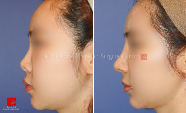 	Harmony-Rhinoplasty, Protruded Mouth Correction Rhinoplasty, Revision Rhinoplasty	 - Rib cartilage rhinoplasty-silicone infection