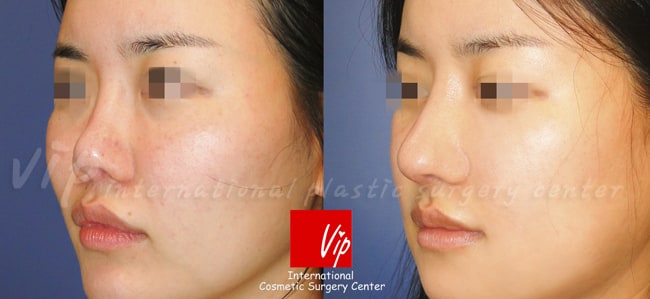 	Harmony-Rhinoplasty, Protruded Mouth Correction Rhinoplasty, Contracted Nose	 - Ribcartilage rhinoplasty - Improvement of mouth protrusion