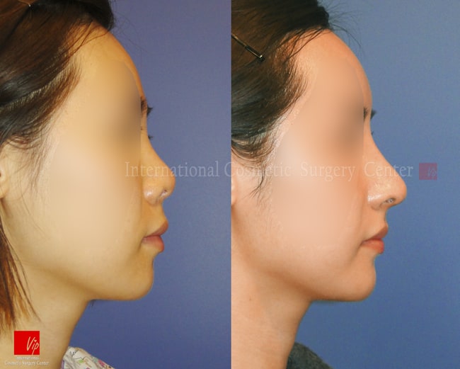 	Harmony-Rhinoplasty, Protruded Mouth Correction Rhinoplasty, Rib cartilage Rhinoplasty, Contracted Nose, Revision Rhinoplasty	 - Harmony rhinoplasty