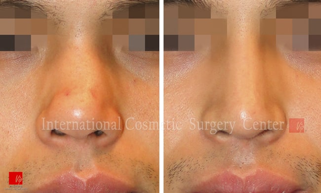 	Rib cartilage Rhinoplasty, Contracted Nose, Revision Rhinoplasty	 - Nasal septal deviation Revision case