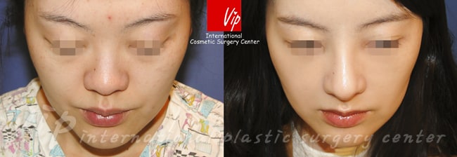 	Harmony-Rhinoplasty, Protruded Mouth Correction Rhinoplasty, Rib cartilage Rhinoplasty	 - Ribcartilage rhinoplasty