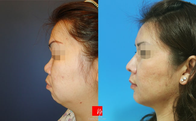 	Nose Surgery, Harmony-Rhinoplasty, Rib cartilage Rhinoplasty, Facial Bone Surgery	 - Harmony Face which includes rhinoplasty and genioplasty