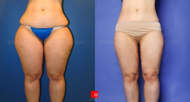 	Body Contouring	 - Body Liposuction