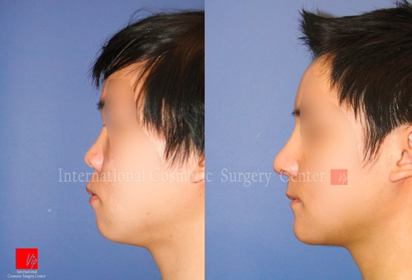 	Harmony-Rhinoplasty, Protruded Mouth Correction Rhinoplasty, Rib cartilage Rhinoplasty, Facial Bone Surgery	 - VIP Harmony face surgery