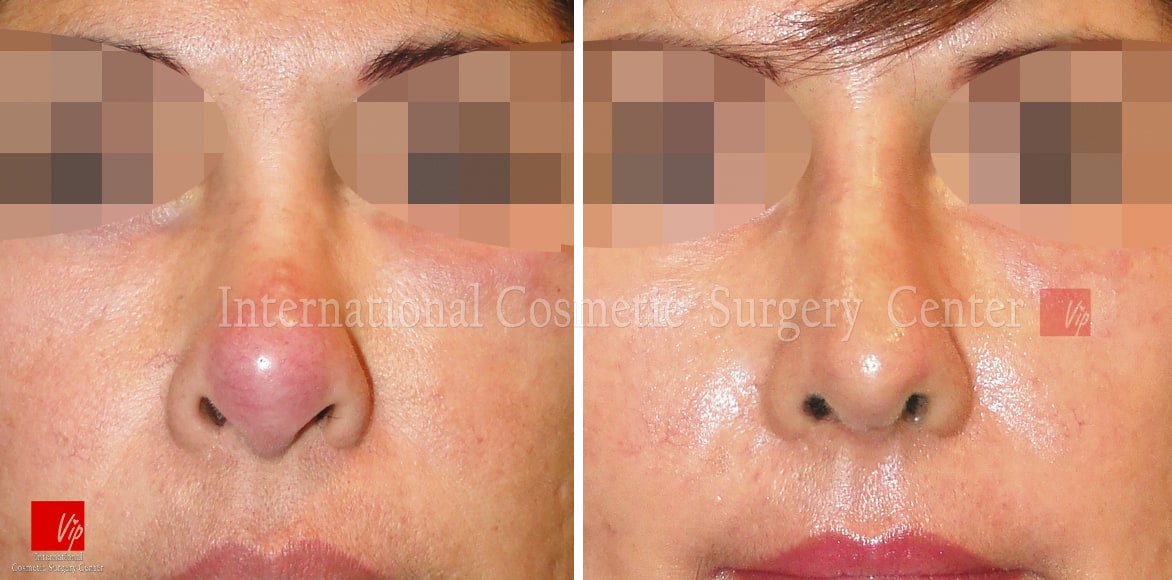 	Rib cartilage Rhinoplasty, Revision Rhinoplasty, Each Cases Nose	 - Infection by illegal procedure