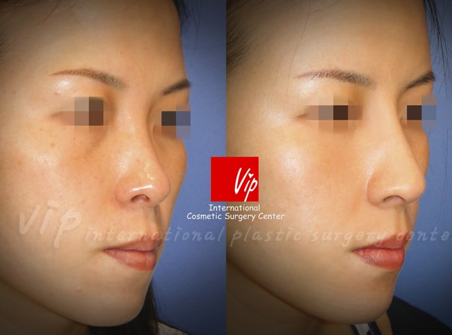 	Nose Surgery, Harmony-Rhinoplasty, Rib cartilage Rhinoplasty	 - Harmony rhinoplasty with Rib cartilage