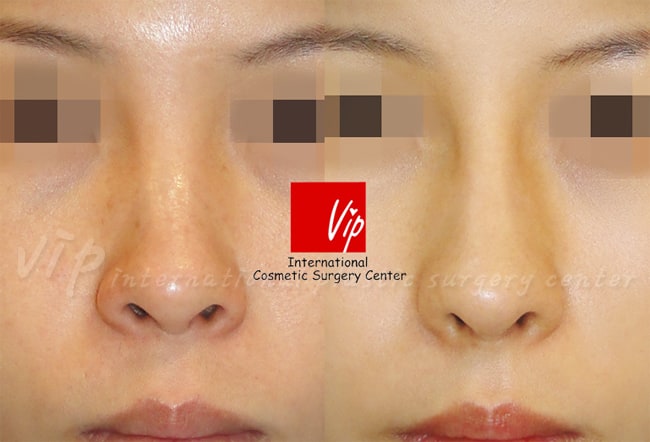 	Nose Surgery, Harmony-Rhinoplasty, Rib cartilage Rhinoplasty	 - Harmony rhinoplasty with Rib cartilage