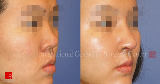 	Harmony-Rhinoplasty, Protruded Mouth Correction Rhinoplasty, Rib cartilage Rhinoplasty	 - Flat nose correction