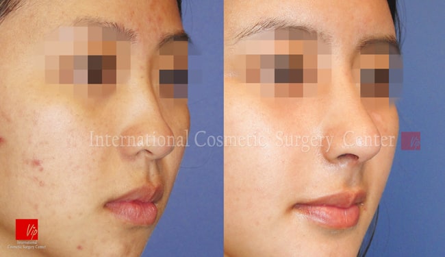 	Nose Surgery, Rib cartilage Rhinoplasty, Stem Cell Fat Graft	 - Autologous Rhinoplasty and Fat graft