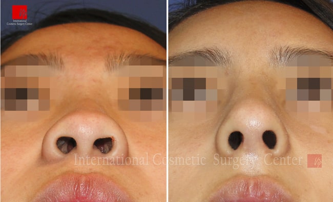 	Nose Surgery, Rib cartilage Rhinoplasty, Stem Cell Fat Graft	 - Autologous Rhinoplasty and Fat graft