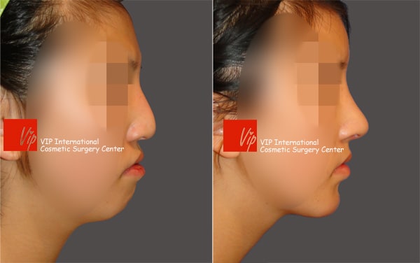 Facial Bone Surgery - Humped nose correction (protruded mouth improvement as well)- Rib cartilage rhinoplasty