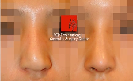 Facial Bone Surgery - Humped nose correction (protruded mouth improvement as well)- Rib cartilage rhinoplasty