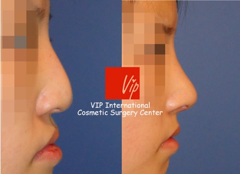 Facial Bone Surgery - Humped nose correction (protruded mouth improvement as well)- Rib cartilage rhinoplasty