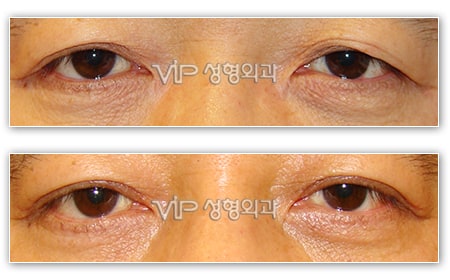 Eye Surgery - Upper blepharoplasty