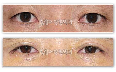 Eye Surgery - Upper & Lower blepharoplasty