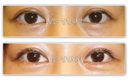 Eye Surgery - Smiley eyes surgery