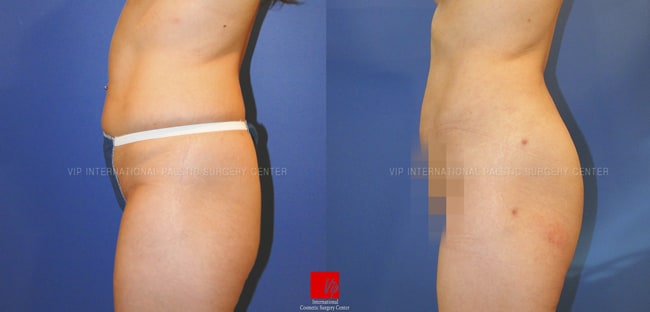 	Stem Cell Fat Graft, Body Contouring	 - Buttocks augmentation with fat graft