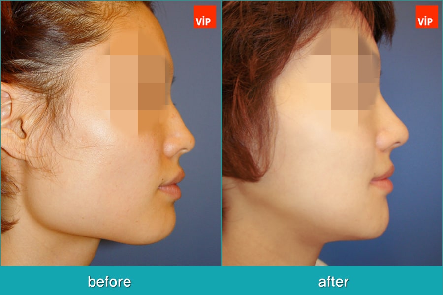 	Nose Surgery, Septal Deviation, Facial Bone Surgery	 - Septal Cartilage Rhinoplasty, Face Contouring Surgery, V-line Surgery, Cheekbone Reduction