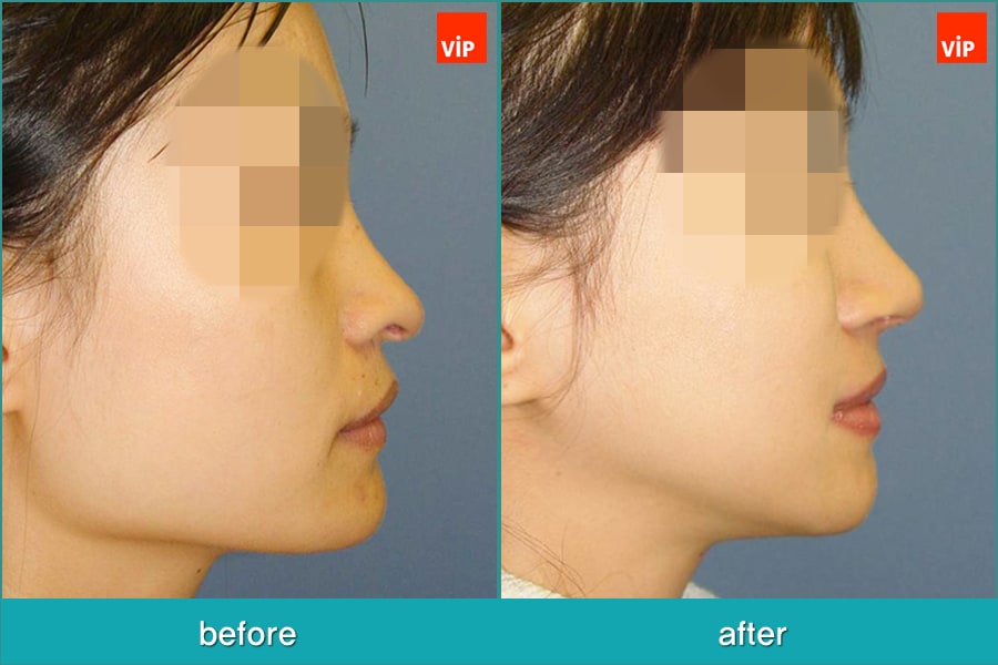 	Nose Surgery, Septal Deviation, Facial Bone Surgery	 - Rhinoplasty and Deviated Septum Surgery, Face Contouring Surgery, Jawline Reduction