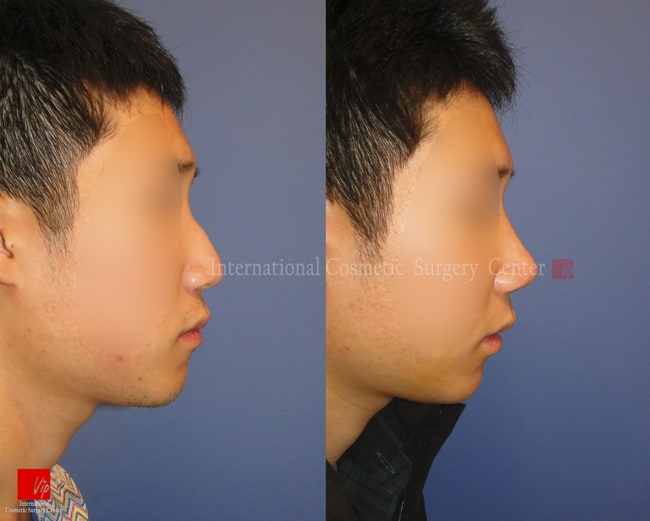 	Nose Surgery, Harmony-Rhinoplasty, Each Cases Nose, Septal Deviation	 - Septal deviation