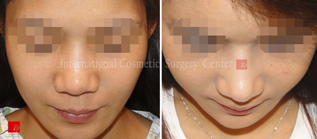 	Nose Surgery, Harmony-Rhinoplasty, Each Cases Nose	 - Harmony face surgery