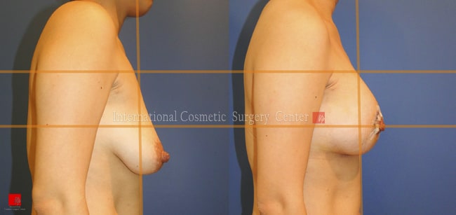 	Breast Surgery, Body Contouring	 - Breast lift & augmentation