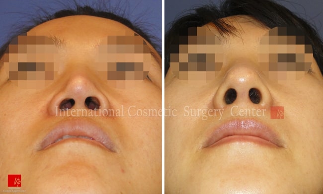 	Harmony-Rhinoplasty, Protruded Mouth Correction Rhinoplasty, Rib cartilage Rhinoplasty, Revision Rhinoplasty, Septal Deviation	 - Revision rhinoplasty using Rib cartilage