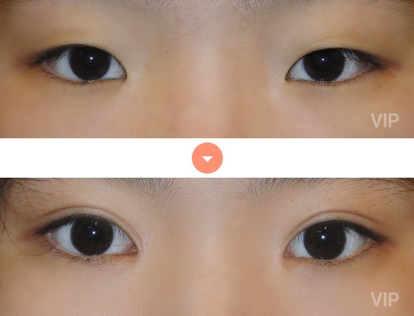 Eye Surgery - Double Eyelid Surgery