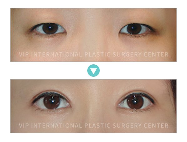 Eye Surgery - Double Eyelid Surgery