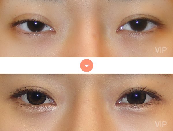 Eye Surgery - Double Eyelid Surgery