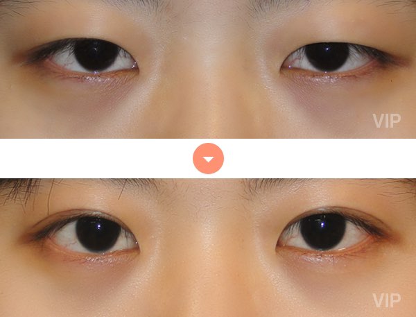 Eye Surgery - Double Eyelid Surgery