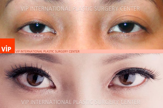 	Eye Surgery, Double Fold, Ptosis Correction	 - Ptosis correction