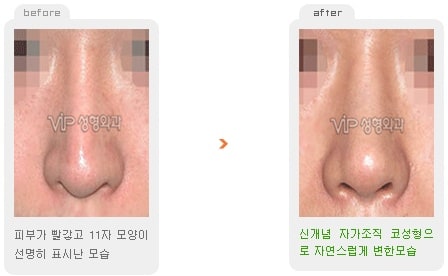 	Nose Surgery, Revision Rhinoplasty	 - Revision rhinoplasty - Silicone showing nose